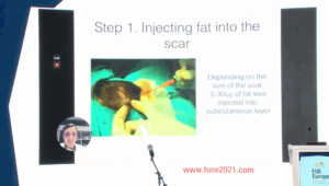 Goran Kuka-Epstein, MD - The Role of Adipose Tissue and Regenerative Cells in Treating Hair Loss   &    Results of a Randomized Trial Using Kerastem
